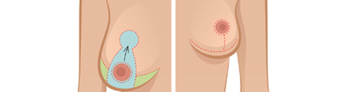 Уменьшении или изменении формы груди