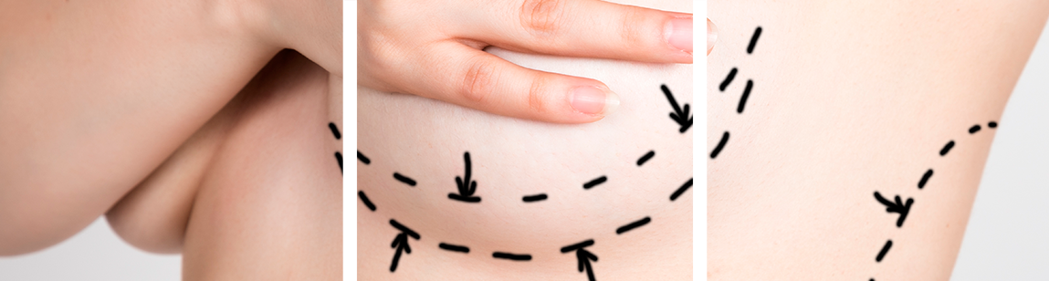 Осложнения и побочные эффекты хирургического уменьшения или изменения формы груди